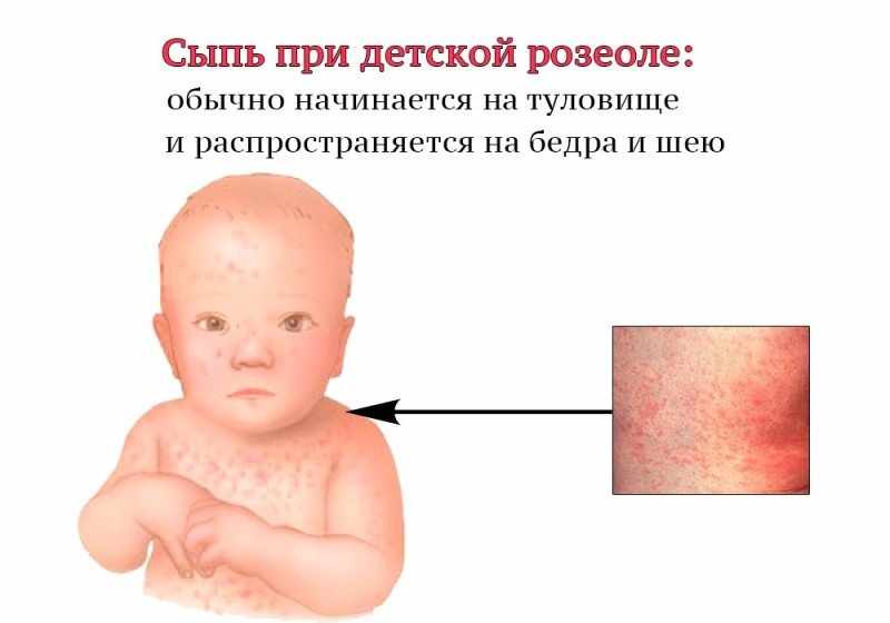 высыпания при розеоле