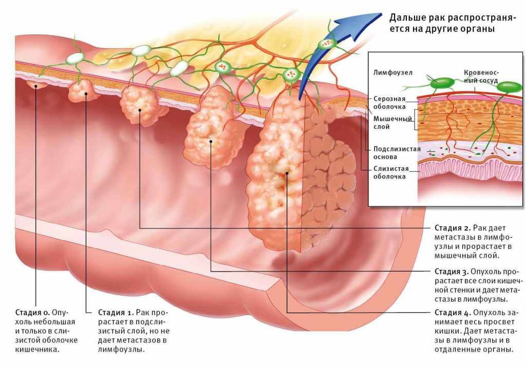 рак кишечника и его развитие 