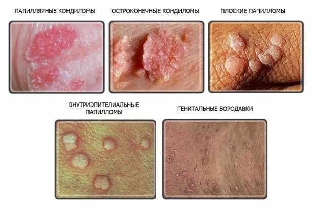 виды ВПЧ