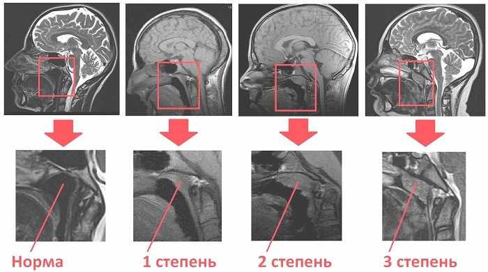 степени развития аденоидов