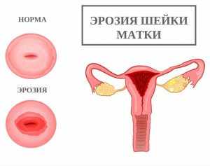 изображение эрозии шейки матки