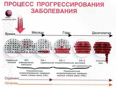 так развивается впч