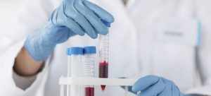 изучение СРБ в биохимическом анализе крови