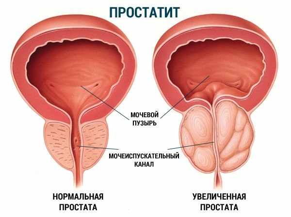 так выглядит простатит