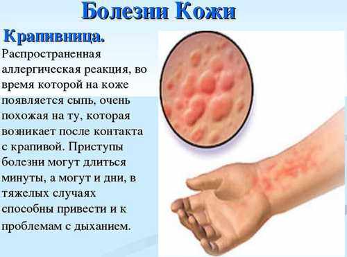 причины крапивницы