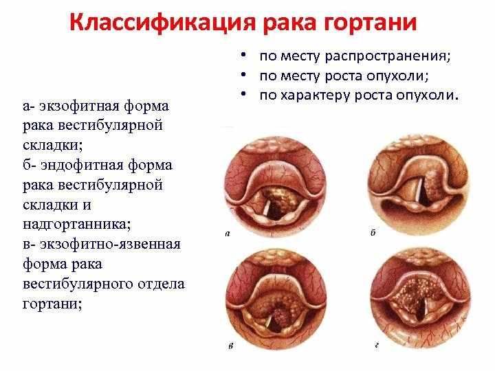 рак горла и его классификация