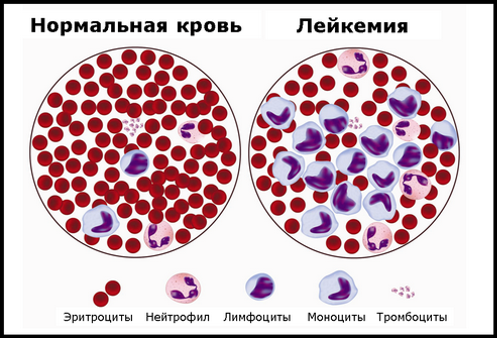 фото нормальной крови и лейкемии