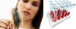 анализы при выпадении волос
