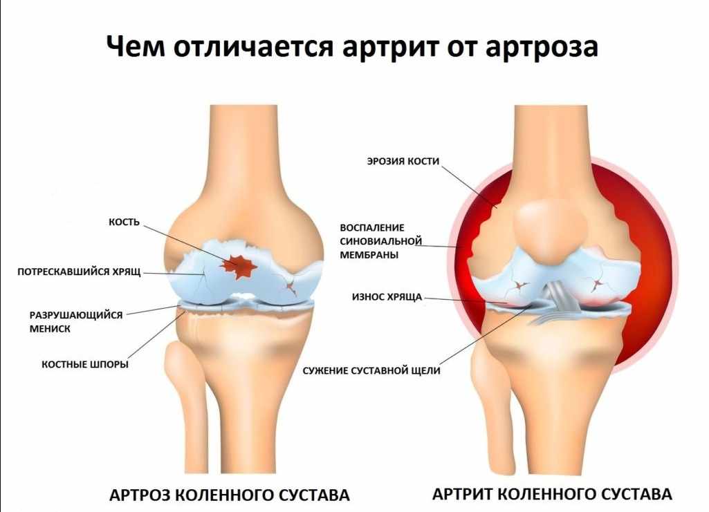 основные отличия артрита и артроза