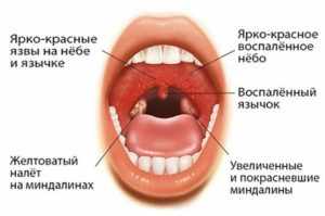 инфекционный мононуклеоз у детей и его проявления