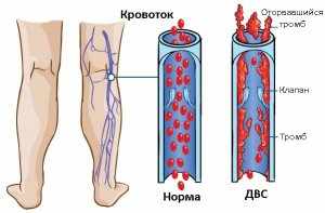 ДАС-синдром – очень опасное нарушение системы гемостаза
