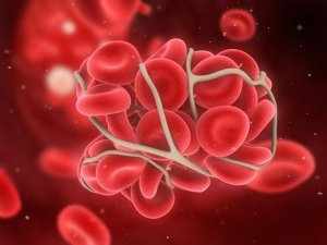Повышенная свертываемость крови может стать причиной тяжелых сосудистых заболеваний