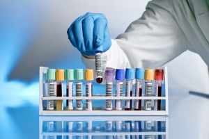 Биохимический анализ крови – эффективная диагностика уровня билирубина
