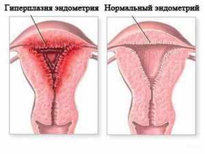 Гиперплазия эндометрия – это патологическое разрастание клеток эндометрия