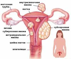 Главная причина возникновения миомы матки – гормональный дисбаланс 