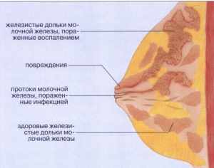 Неправильное лечение лактостаза может вызвать мастит, признаком которого является воспаление ткани молочной железы
