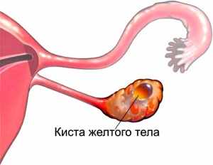 Причины и симптомы кисты желтого тела