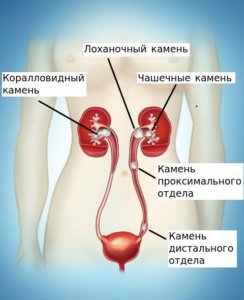 локализации камня