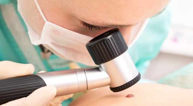 что означает каждая стадия меланомы