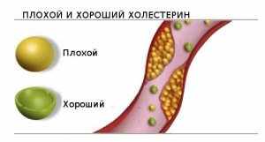 «Плохой», «хороший» и общий холестерин