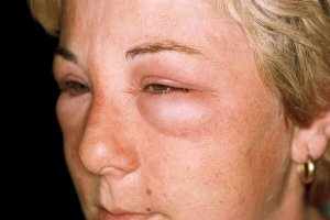 Аллергия опасна своими осложнениями