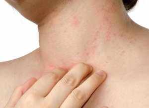 Симптомы аллергии зависят от того, какой орган реагирует на аллерген 