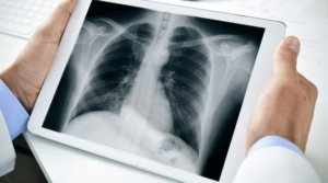 диагноз бронхиальной астме
