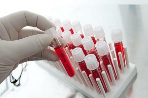 Биохимический анализ крови поможет определить уровень холестерина