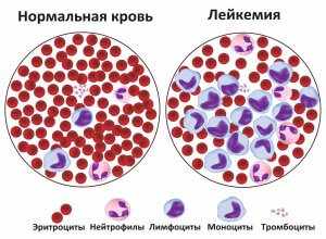 Выявить патологию можно с помощью общего анализа крови