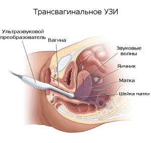 Трасвагинальное УЗИ запрещается проводить во 2 и 3 триместре беременности