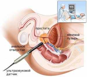 УЗИ – эффективный инструментальный метод обследования состояния простаты 