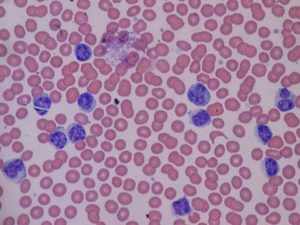 Лимфоциты в крови повышены