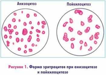 Форма эритроцитов при анизоцитозе и пойкилоцитозе
