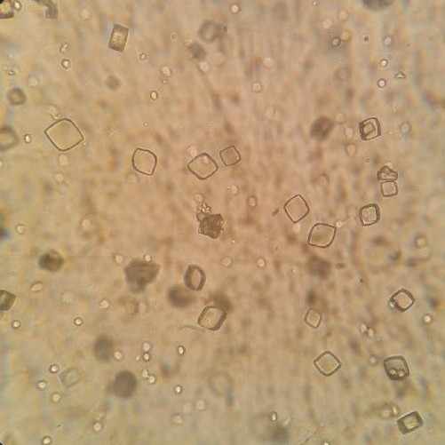 Песок в моче под микроскопом