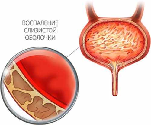 Цистит