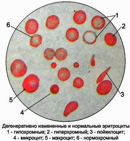 Изменённые и нормальные эритроциты