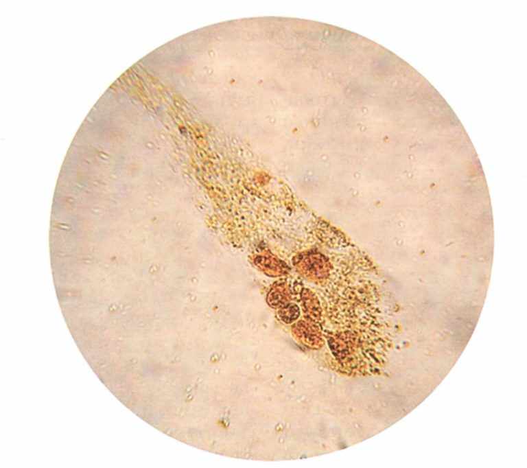 Эпителий в моче под микроскопом
