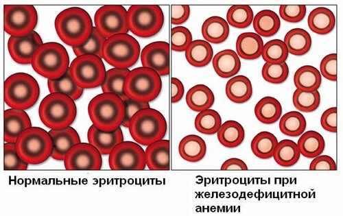 Эритроциты при анемии