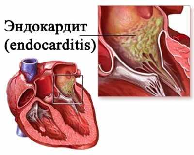 Септический эндокардит