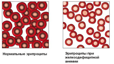 Железодефицитная анемия