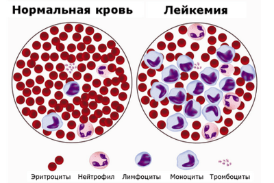 белокровие
