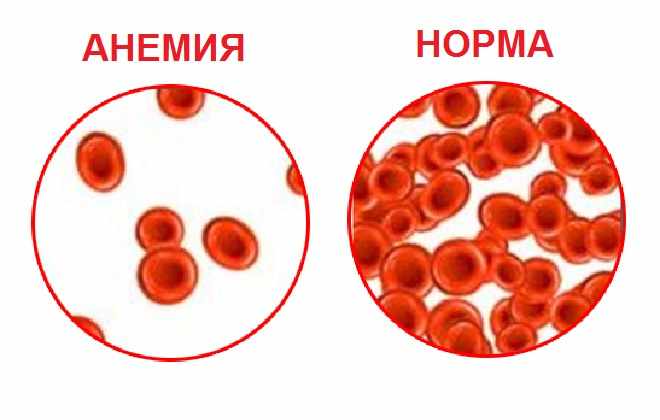 Сравнение крови здоровых людей и заболевших анемией
