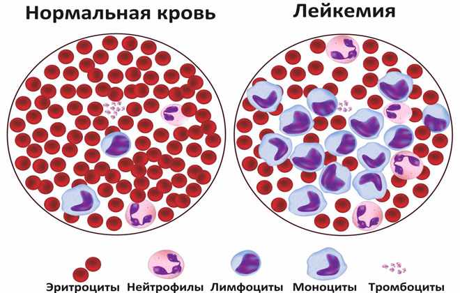 Рак крови