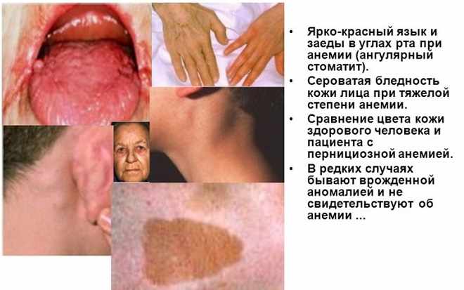 Клинические проявления анемии
