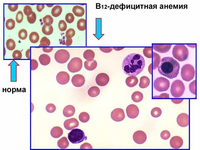 Клетки крови при анемии