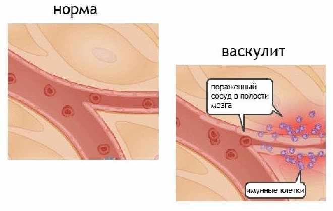 Признаки поражения иммунной системы человека васкулитом