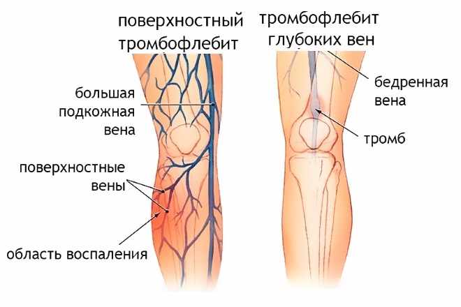 Разновидности тромбофлебита