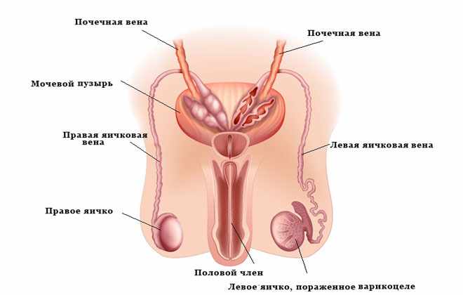 Варикоцеле, и ее влияние на потенцию