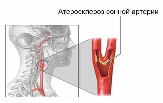 Отложение плохого холестерина в сонной артерии