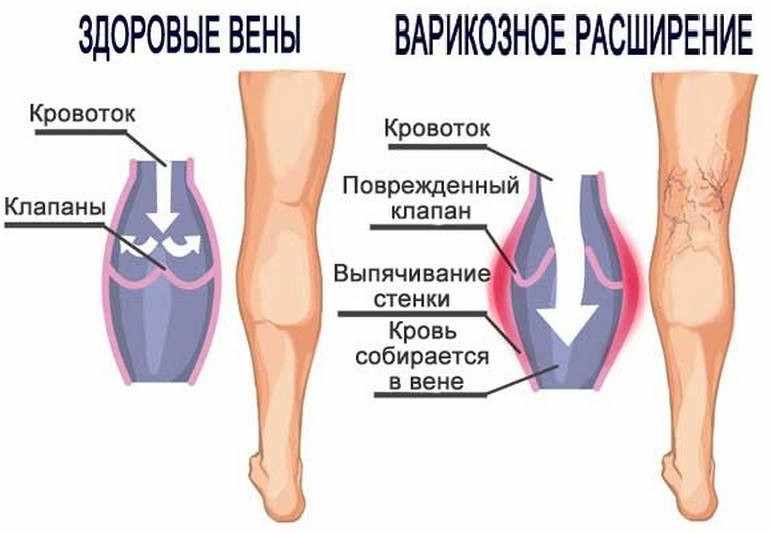 Венозные клапаны